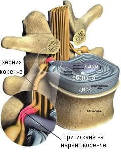 Упражнения лечение и облекчаване на дисковата херния 8 Diskova hernia search 2