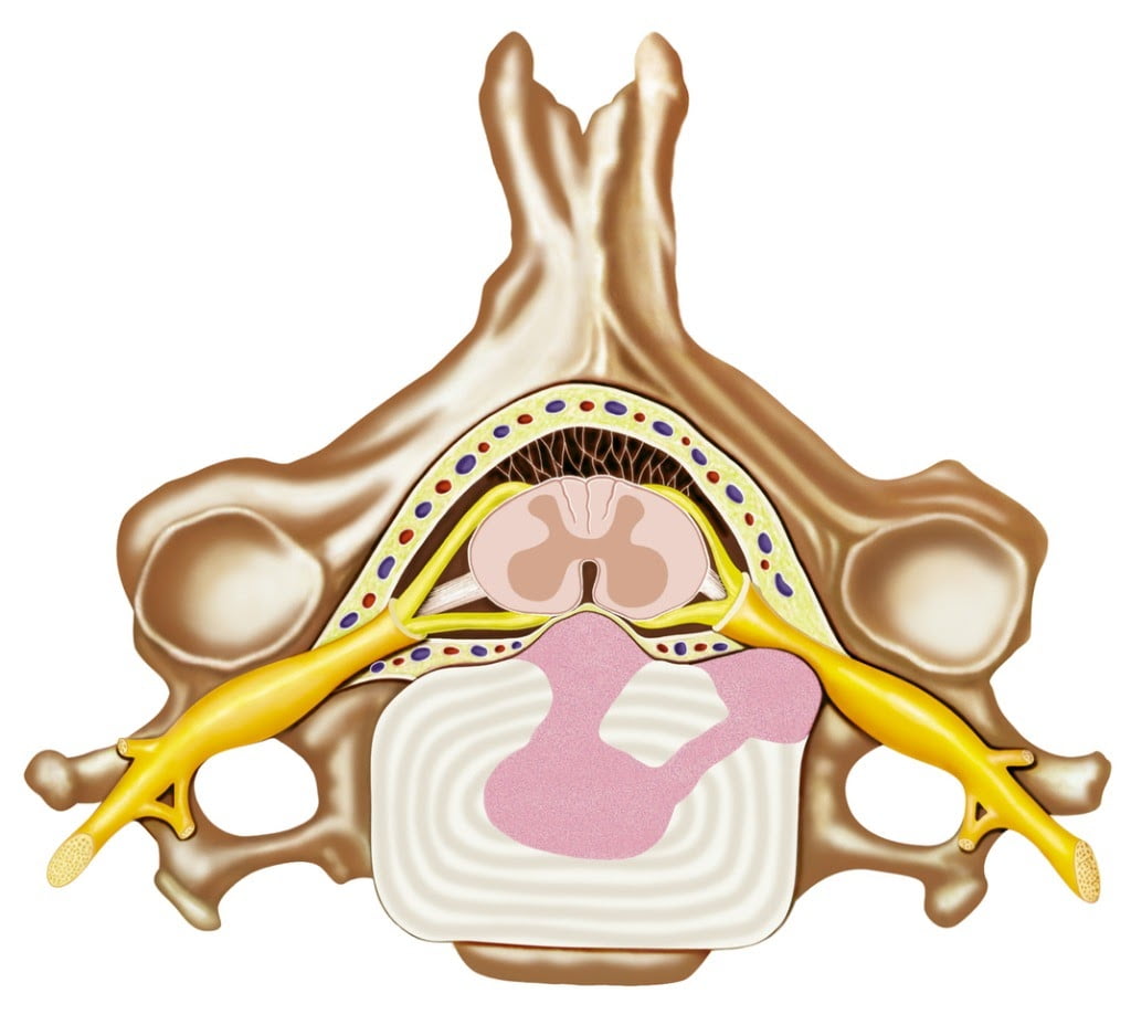 Дискова херния: лечение симптоми, причини, диагностика 8 herniared disc manual therapy