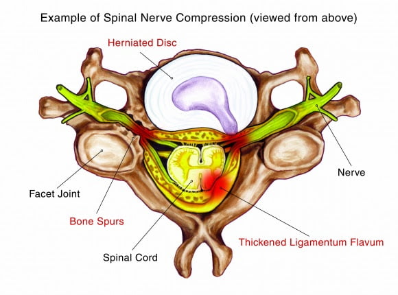Спондилоза, причини, диагностика и лечение 7 spondiloza lechenie manual therapy