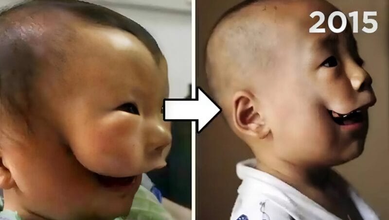 Това момче се роди с необичайно лице и когато майката го видя за първи път, замръзна от ужас... 8 erku demq1