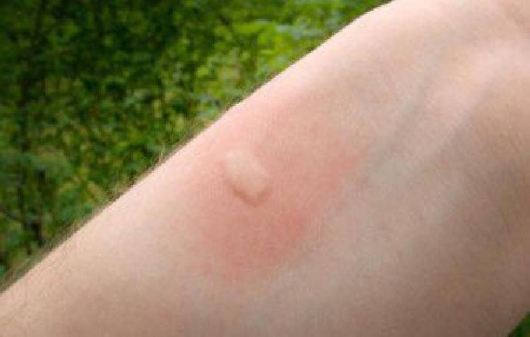 8 вида ухапвания от насекоми, които просто сте длъжни да разпознавате! 13 insects bite 1 1526728496516