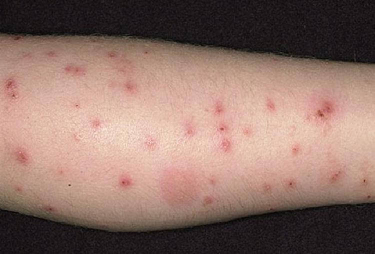 8 вида ухапвания от насекоми, които просто сте длъжни да разпознавате! 14 insects bite 2 1526728496516