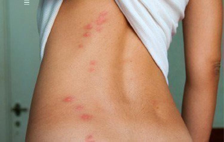 8 вида ухапвания от насекоми, които просто сте длъжни да разпознавате! 15 insects bite 3 1526728496516