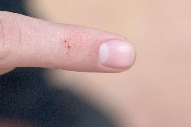 8 вида ухапвания от насекоми, които просто сте длъжни да разпознавате! 16 insects bite 4 1526728496516