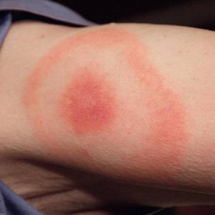 8 вида ухапвания от насекоми, които просто сте длъжни да разпознавате! 17 insects bite 5 1526728496516