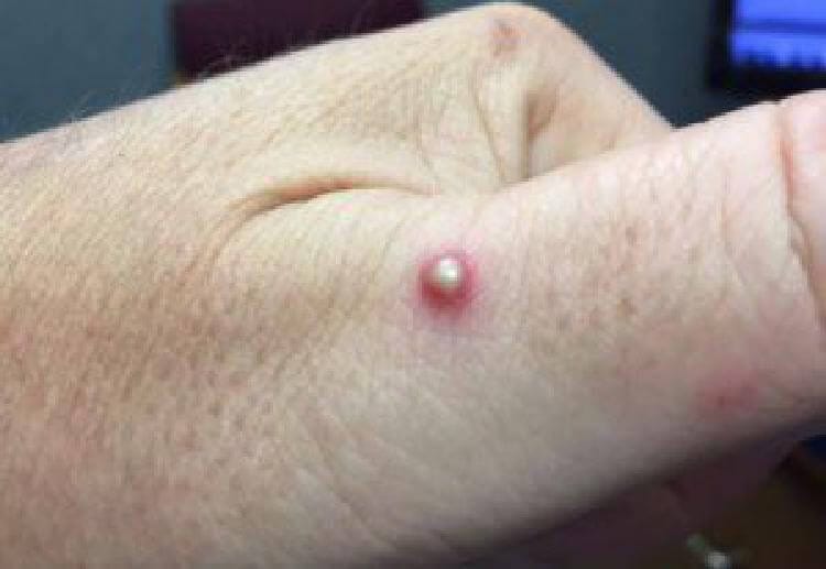 8 вида ухапвания от насекоми, които просто сте длъжни да разпознавате! 18 insects bite 6 1526728496516