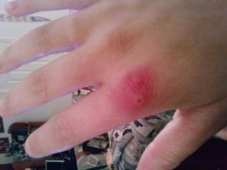 8 вида ухапвания от насекоми, които просто сте длъжни да разпознавате! 19 insects bite 7 1526728496516