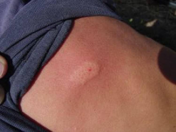 8 вида ухапвания от насекоми, които просто сте длъжни да разпознавате! 20 insects bite 8 1526728496516