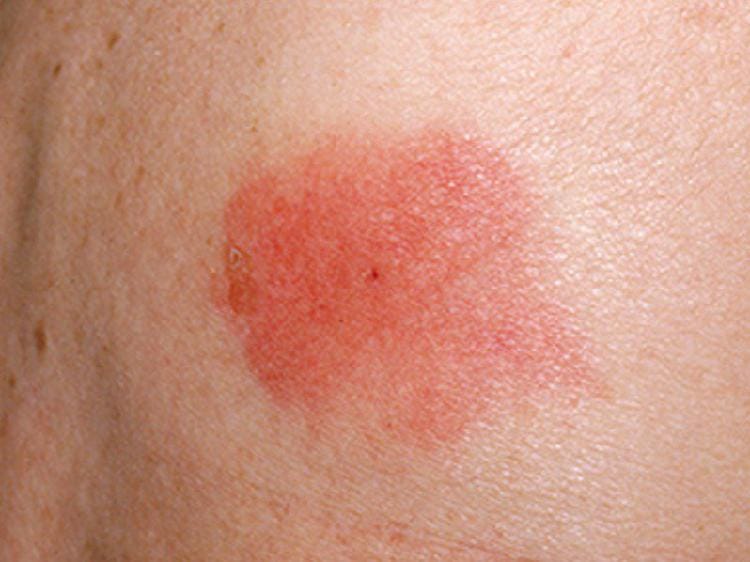 8 вида ухапвания от насекоми, които просто сте длъжни да разпознавате! 21 insects bite 9 1526728496516