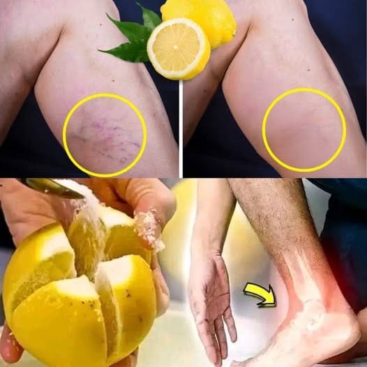 Майчината натурална рецепта 🍋 с лимон: панацея срещу болки в краката 🦵, ревматизъм, разширени вени, артрит, главоболие 🤕 и болки в ставите. 3 494431522 596171163520575 6519309756813701814 n