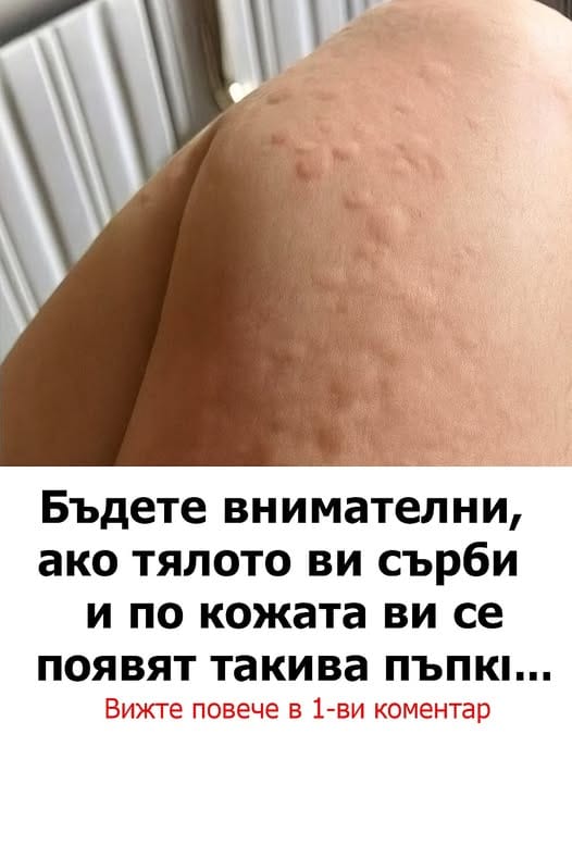 Бъдете внимателни, ако тялото ви сърби и по кожата ви се появят такива пъпки... 3 510981596 742762881430280 2431170781924207783 n